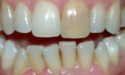 Sbiancamento Dentale