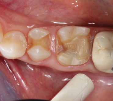 Intarsio dentale
