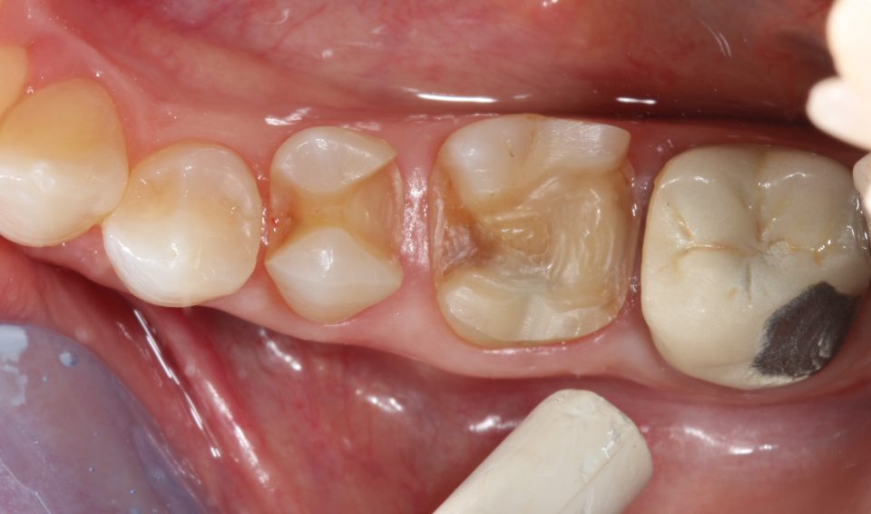 Intarsio dentale